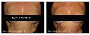 Clear Lake TX breast reduction photos, showing a patient before and after the procedure.