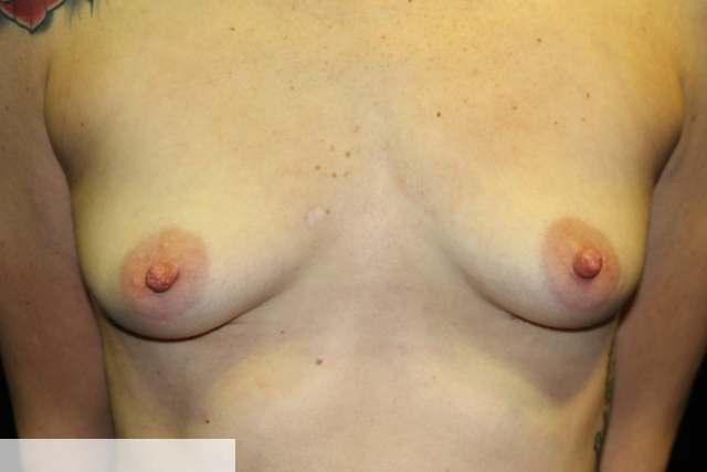 After removal of implants