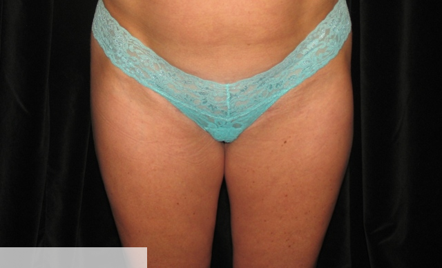 post lipo of outer thighs